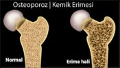 KEMİK ERİMESİ NEDİR ? NEDEN BAŞLAR ? TEDAVİSİ NEDİR ?