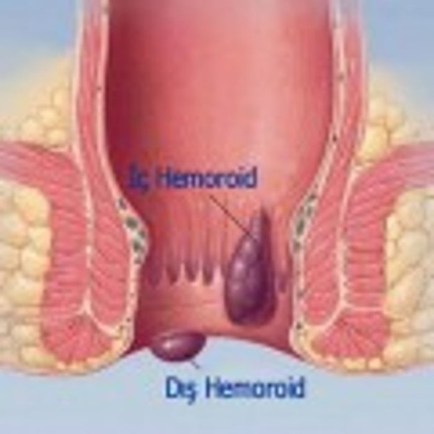 BASUR(HEMOROİD) NEDİR? NASIL TEDAVİ EDİLİR ?