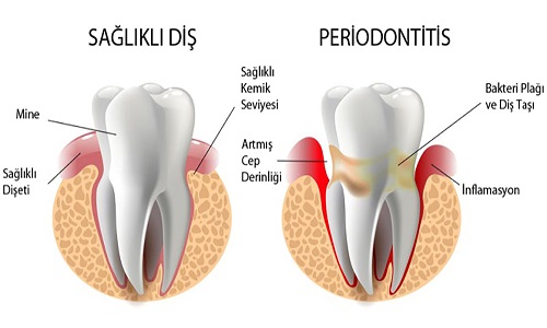 diş hastalıkları